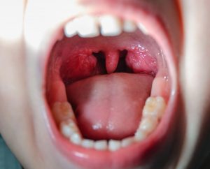 Niño pequeño con la boca abierta muestra las amígdalas inflamadas, un signo característico de la amigdalitis.