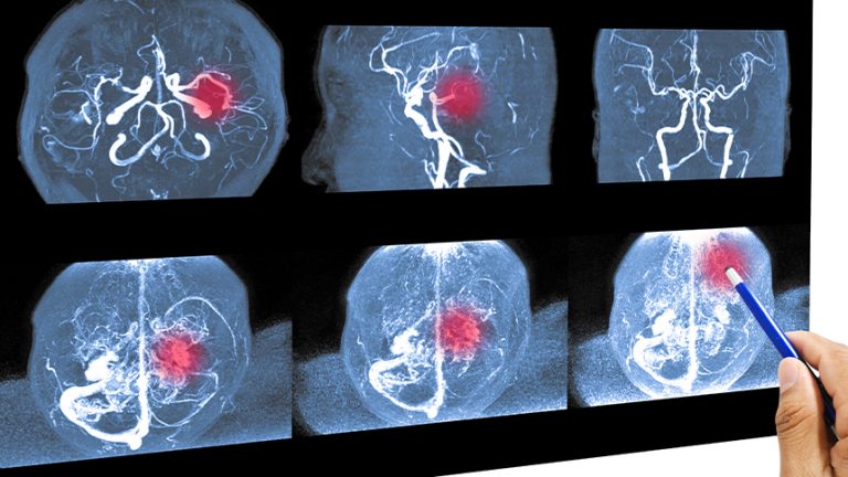 5 causas de un aneurisma cerebrovascular