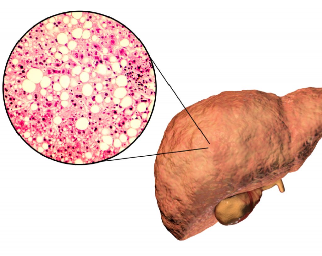 Ilustración de diagrama en 3D de cómo se ve un el hígado graso o esteatosis hepática.