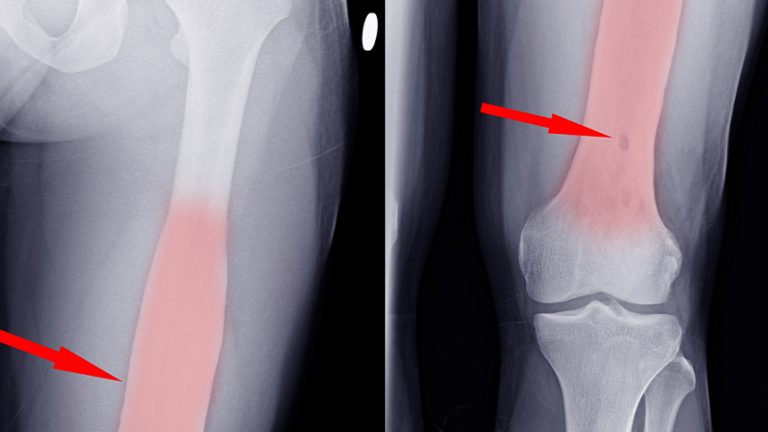 Osteomielitis: Infección de los huesos