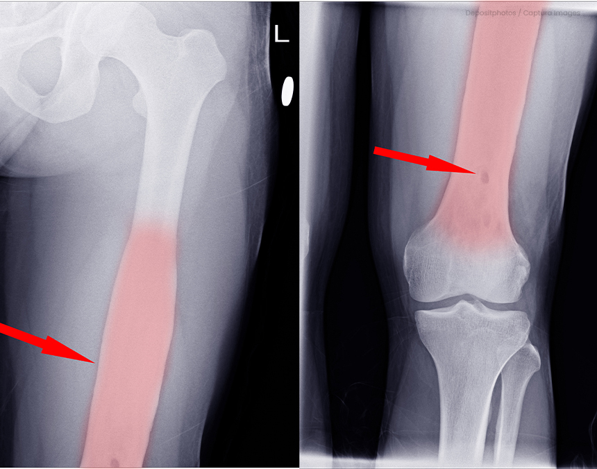Radiografías de una pierna con osteomielitis. El hueso está marcado con rojo