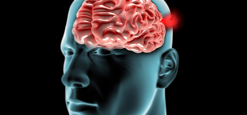 Radiografía de un paciente con un aneurisma cerebral, resaltándolo con una marca roja en el cerebro de color rosa
