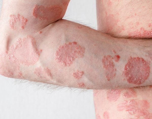 Psoriasis: Una enfermedad crónica de la piel