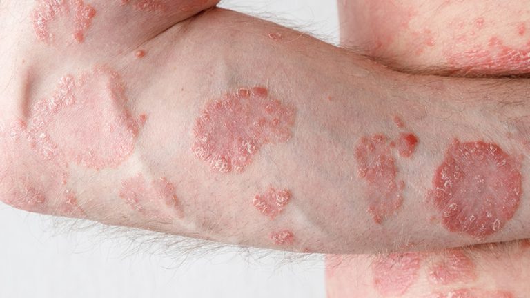 Psoriasis: Una enfermedad crónica de la piel