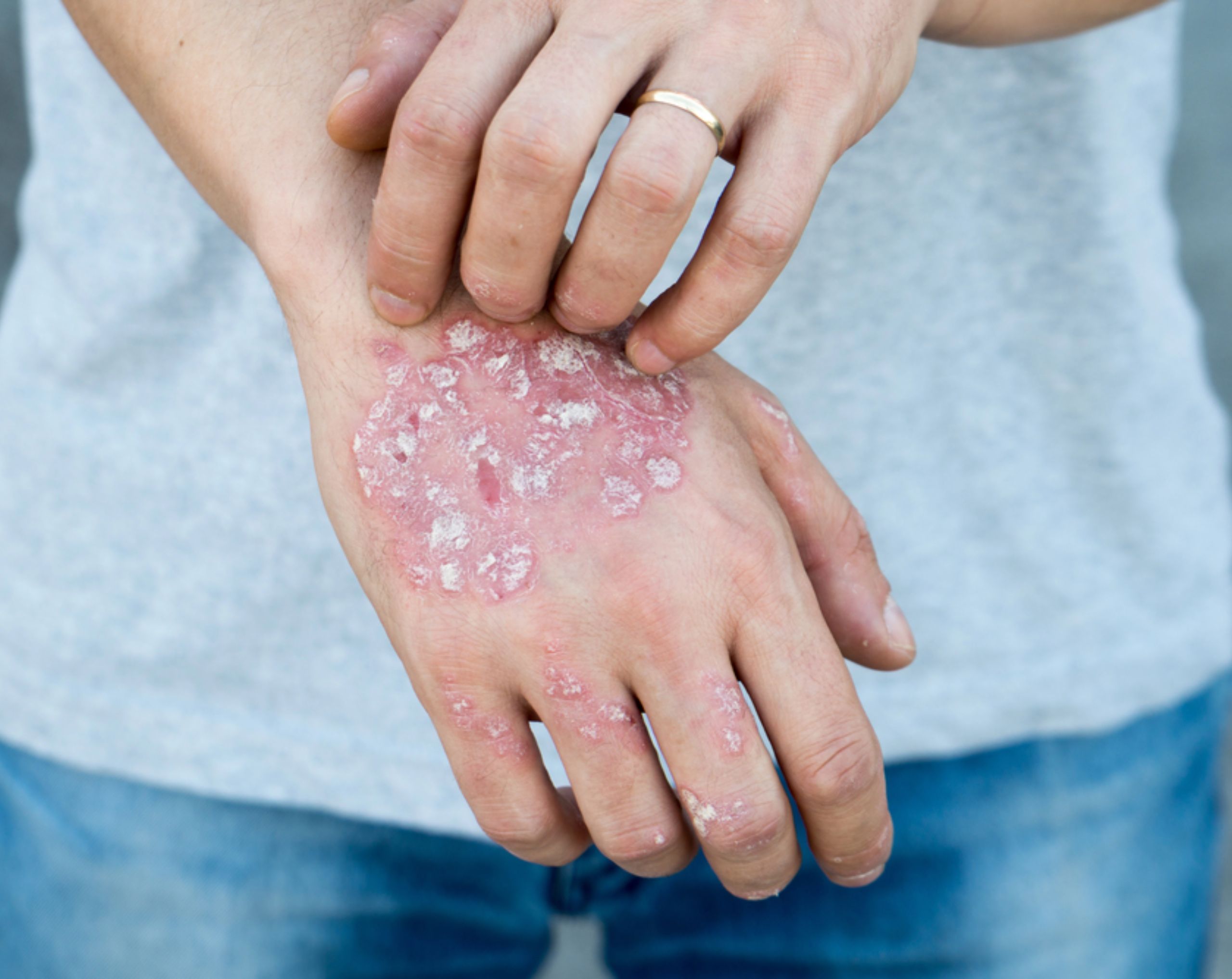 Hombre rascando una zona de la mano con escamas causadas por la psoriasis.