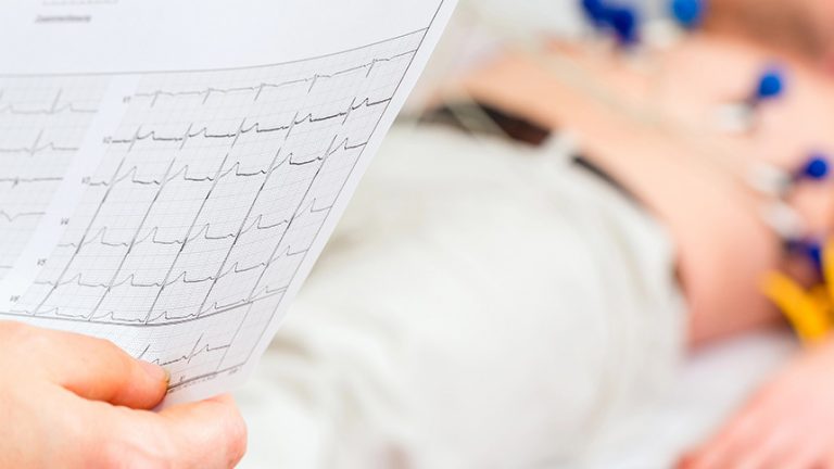 Arritmias cardiacas: tipos y causas