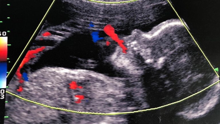 Cardiopatías congénitas: ¿Cómo se diagnostican?