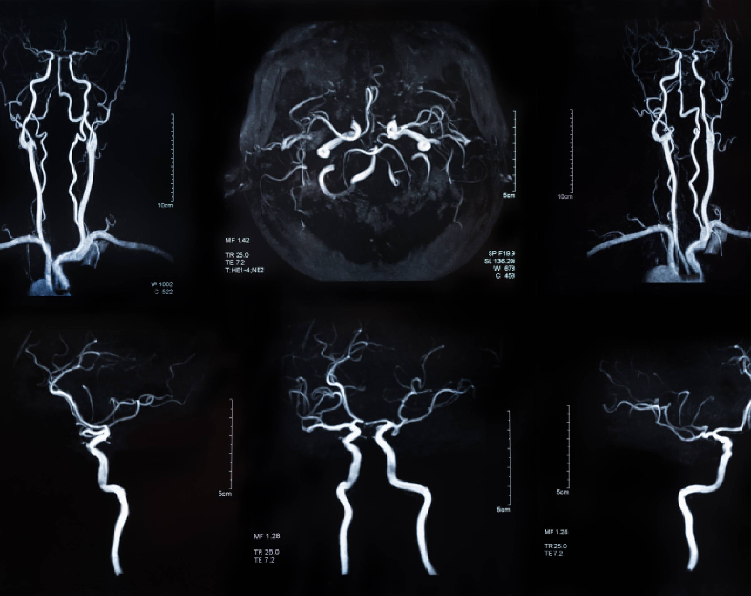 a-qué-se-deben-las-enfermedades-cerebrovasculares