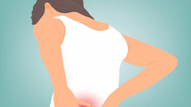 Quiste pilonidal | Factores de riesgo y prevención