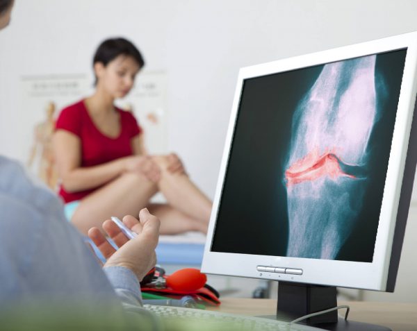 Osteoartritis | Los primeros signos