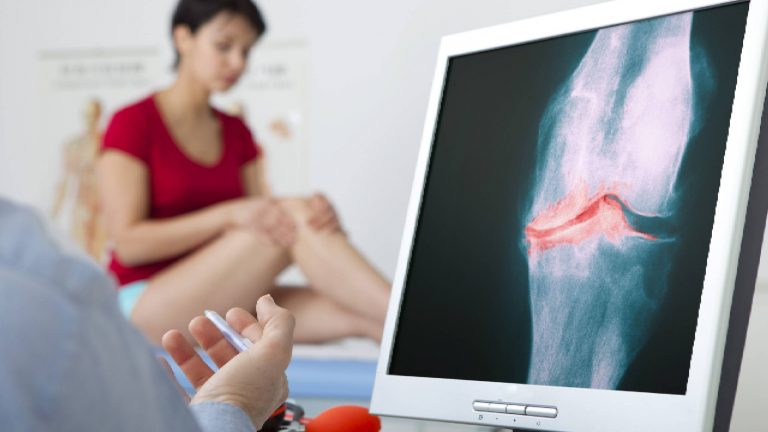 Osteoartritis | Los primeros signos