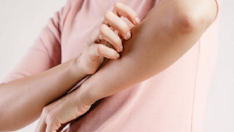 Psoriasis | Síntomas y causas