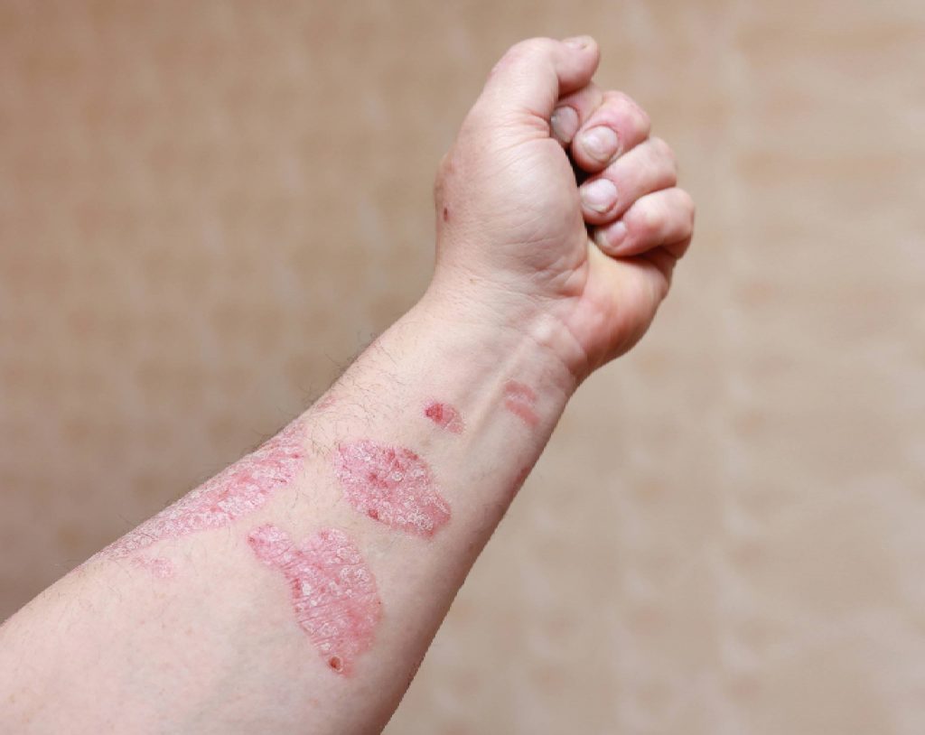 psoriasis-sintomas-y-causas