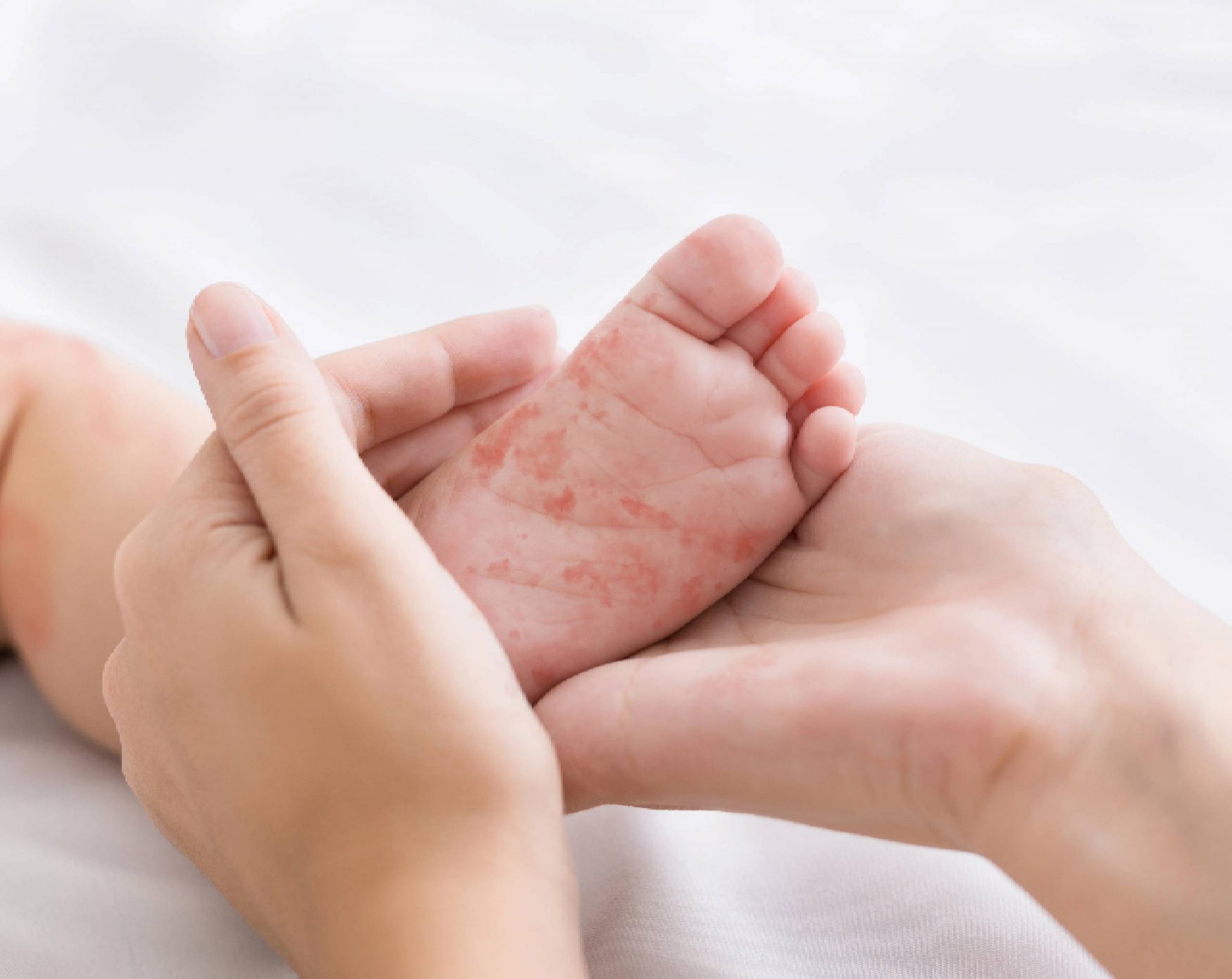El sarampión es una enfermedad viral muy contagiosa que se distingue por una erupción en la piel. Conoce cómo prevenir y tratarla.