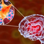 Encefalitis-complicaciones-y-secuelas-posibles