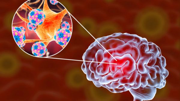 Encefalitis | Complicaciones y secuelas posibles