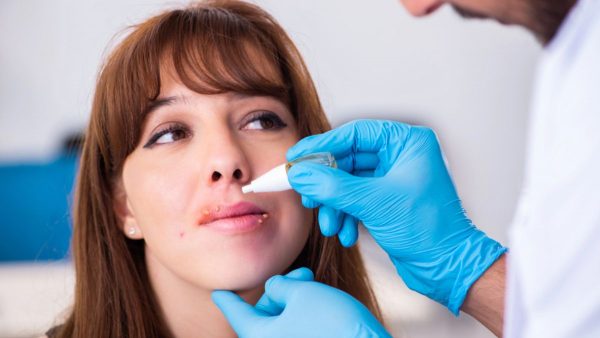¿Qué es el herpes? | ¿Se puede curar? Lo que debes saber