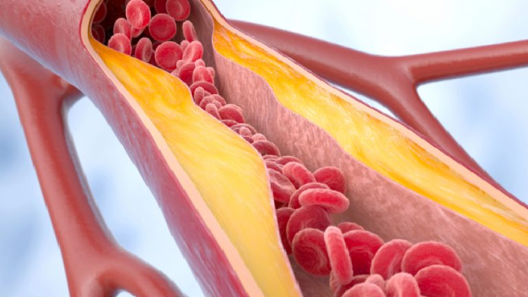 Colesterol LDL | ¿Por qué debemos controlarlo?