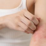 dermatitis-atópica-definición-síntomas-y-tratamiento