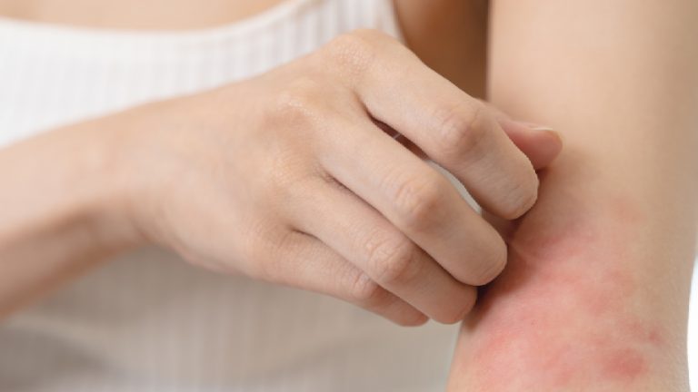 Dermatitis Atópica | Definición, síntomas y tratamiento