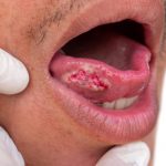 Cáncer-de-lengua-Tiene-manifestaciones-evidentes
