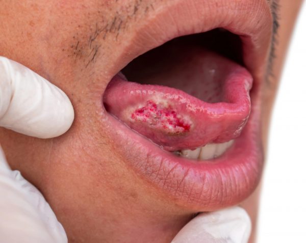 Cáncer de lengua | ¿Tiene manifestaciones evidentes?