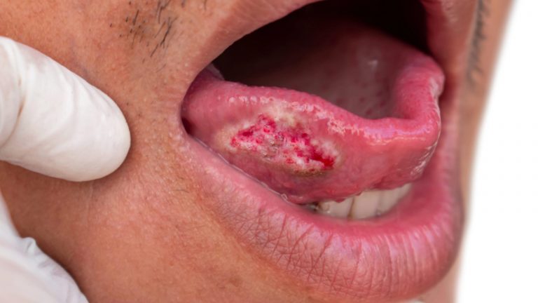Cáncer de lengua | ¿Tiene manifestaciones evidentes?