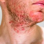 Foliculitis-Qué-es-y-en-qué-consiste