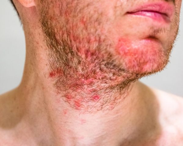 Foliculitis | ¿Qué es y en qué consiste?