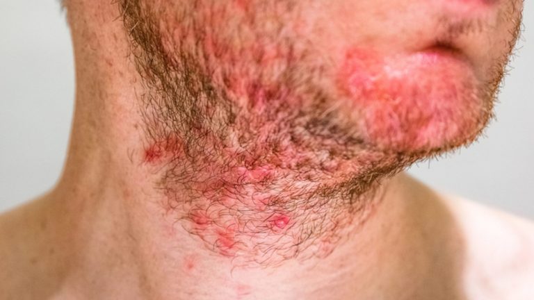 Foliculitis | ¿Qué es y en qué consiste?