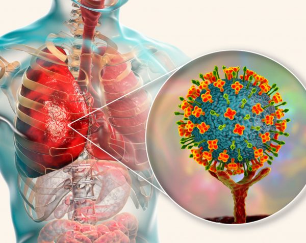 ¿Qué es el Virus Nipah? Síntomas y prevención