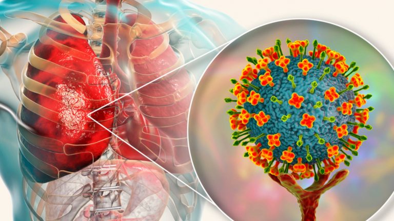 ¿Qué es el Virus Nipah? Síntomas y prevención