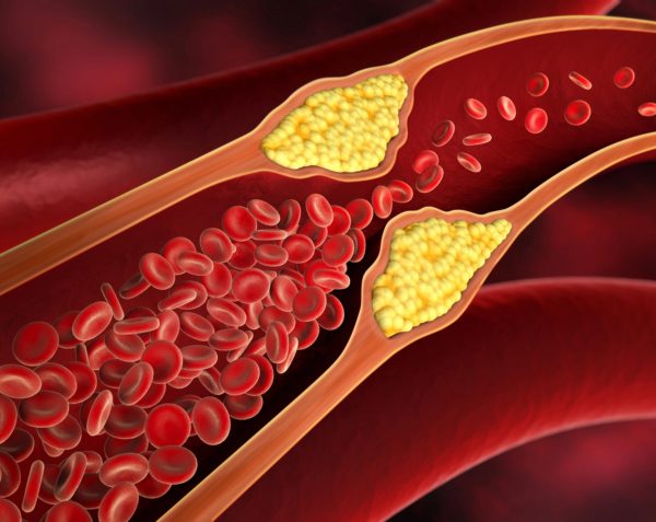 ¿Qué es la aterosclerosis? Factores de riesgo y prevención