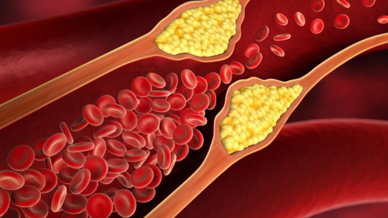 ¿Qué es la aterosclerosis? Factores de riesgo y prevención