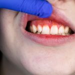 Doctor con guantes de látex azules revisa la boca de un paciente que presenta encías inflamadas y sangrado, signos de gingivitis.