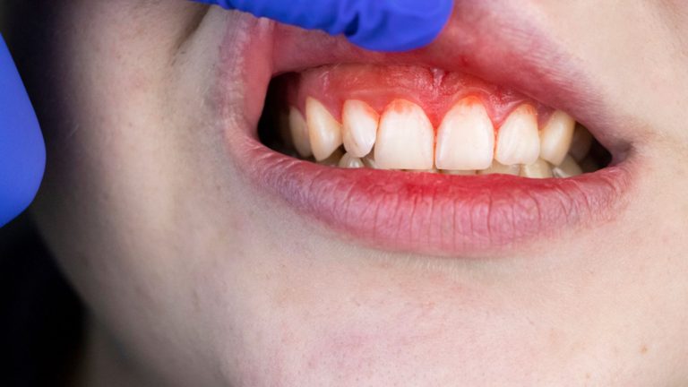 Gingivitis | ¿Qué es y cómo tratarla?