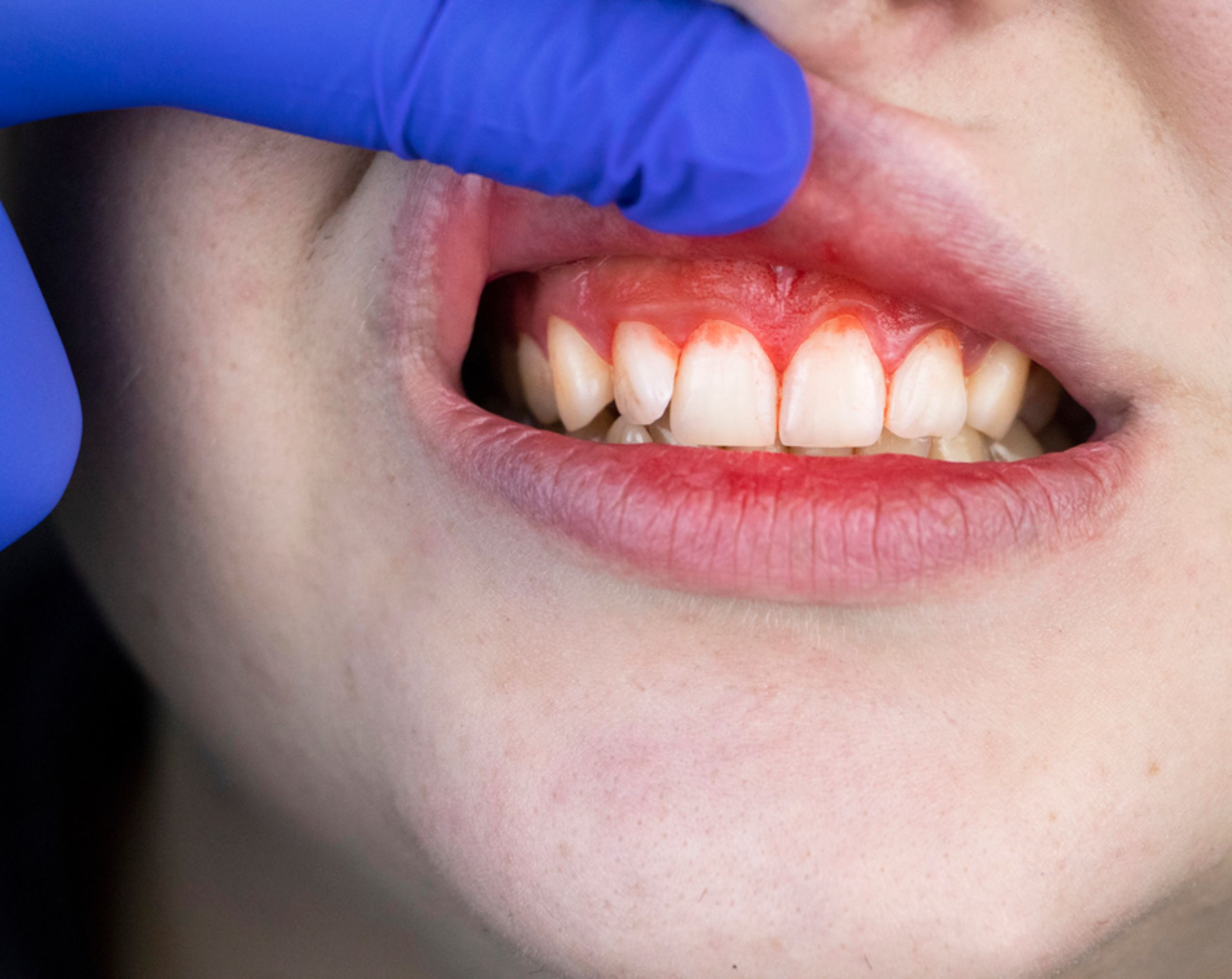 Doctor con guantes de látex azules revisa la boca de un paciente que presenta encías inflamadas y sangrado, signos de gingivitis.