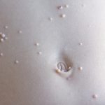 Abdomen de una persona con brotes de molusco contagioso