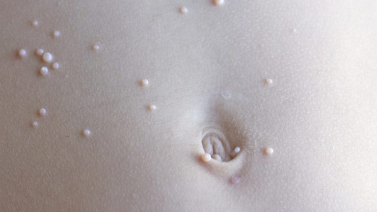 Molusco contagioso: ¿cuál es el tratamiento? 