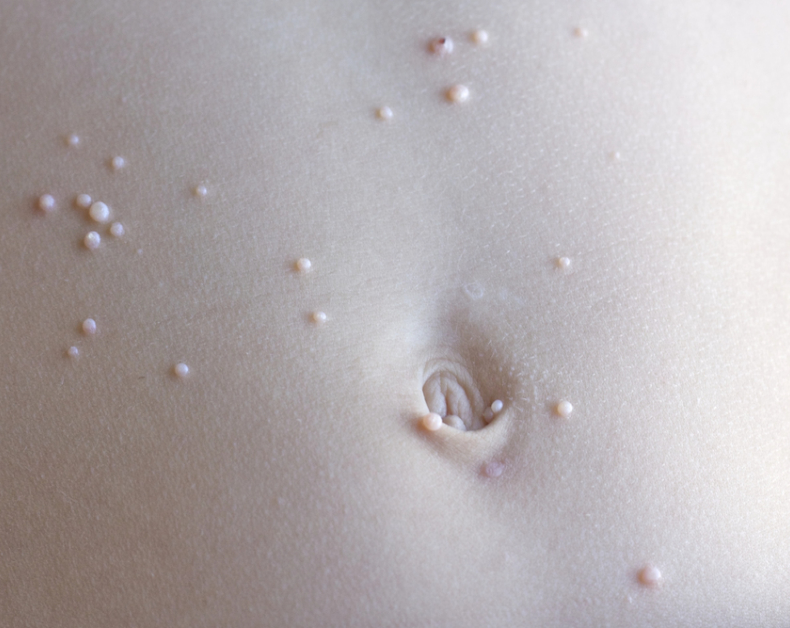 Abdomen de una persona con brotes de molusco contagioso
