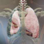 derrame-pleural-puede-causar-la-muerte