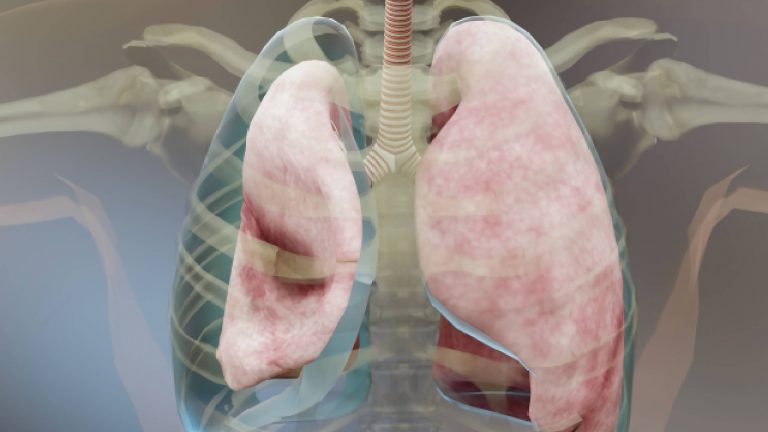 Derrame pleural | ¿Puede causar la muerte?