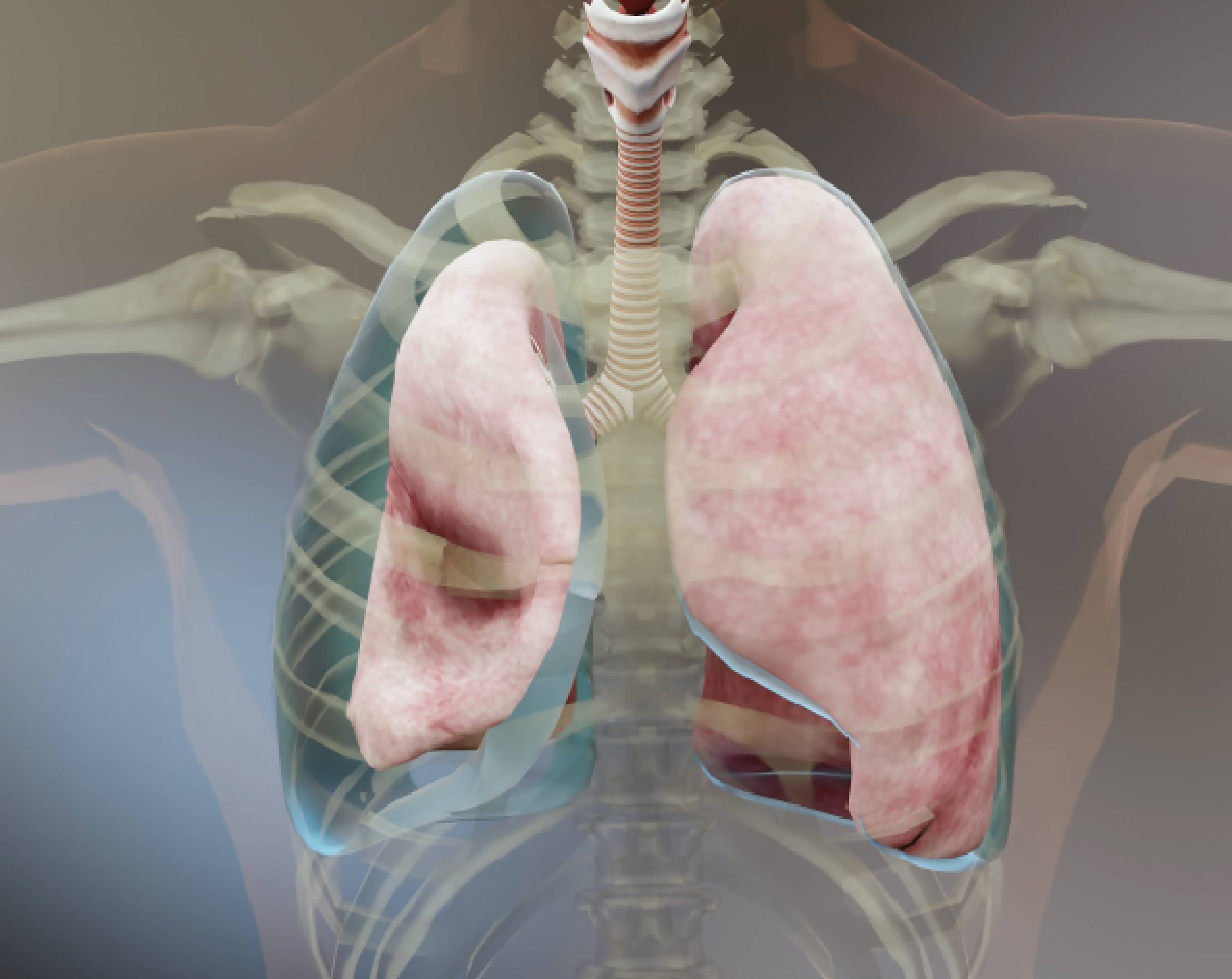 derrame-pleural-puede-causar-la-muerte