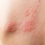 herpes-zóster-definición-y-causas