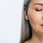 lifting-facial-qué-es-y-en-qué-consiste
