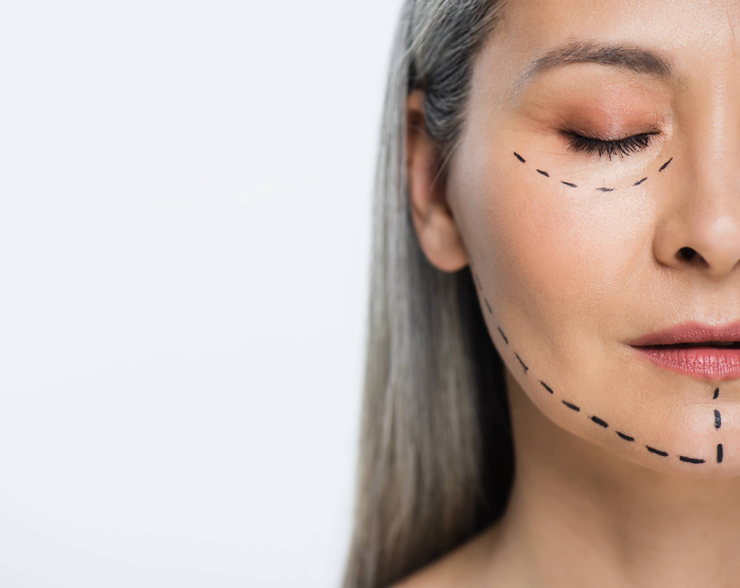 lifting-facial-qué-es-y-en-qué-consiste