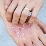 psoriasis-en-la-piel-que-es-y-por-que-aparece