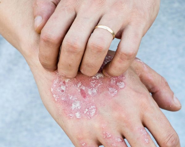 Psoriasis en la piel | ¿Qué es y por qué aparece?