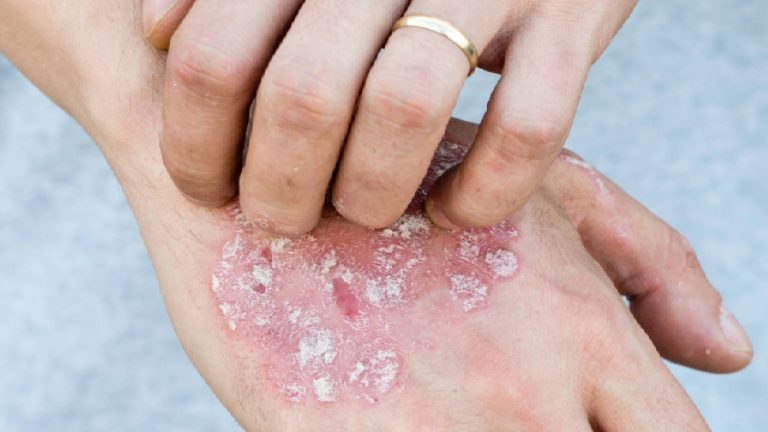 Psoriasis en la piel | ¿Qué es y por qué aparece?