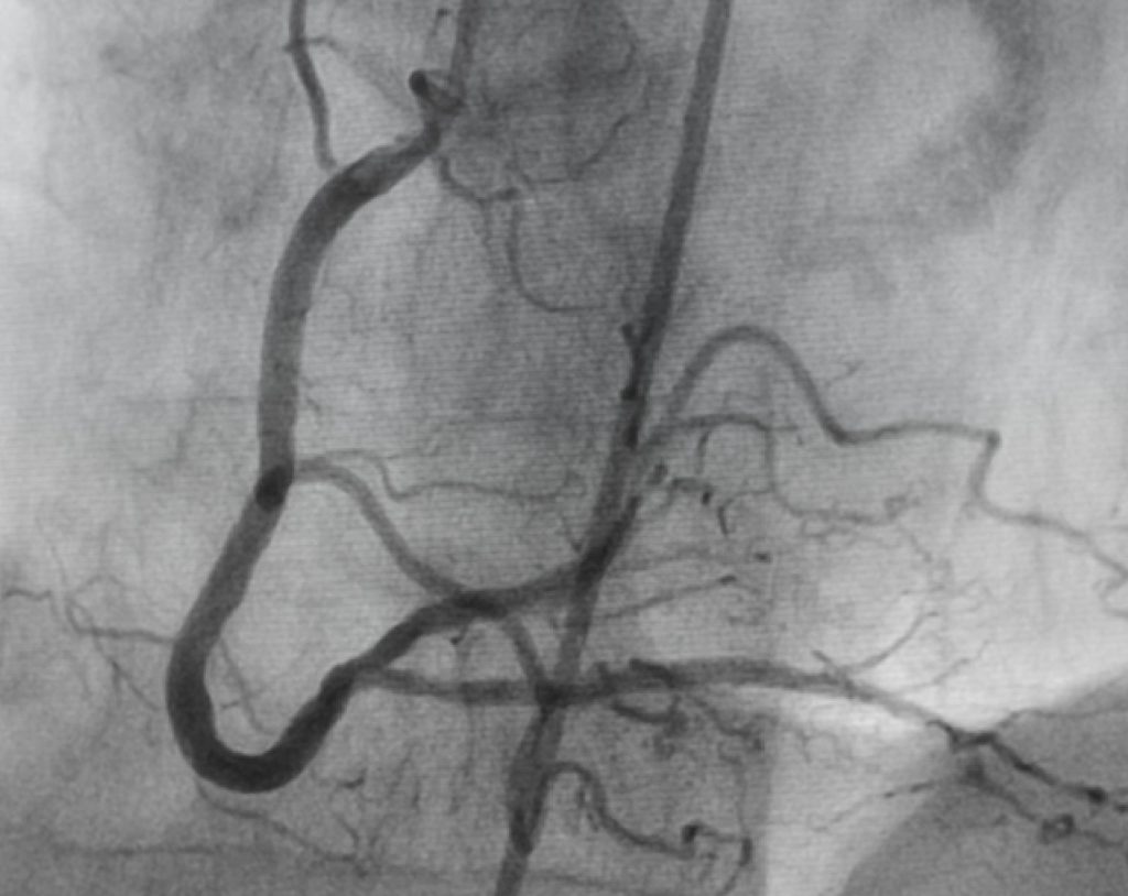 Anatomía radiológica de las arterias en blanco y negro dentro de una sala de Hemodinamia donde se practica la embolización arterial. 